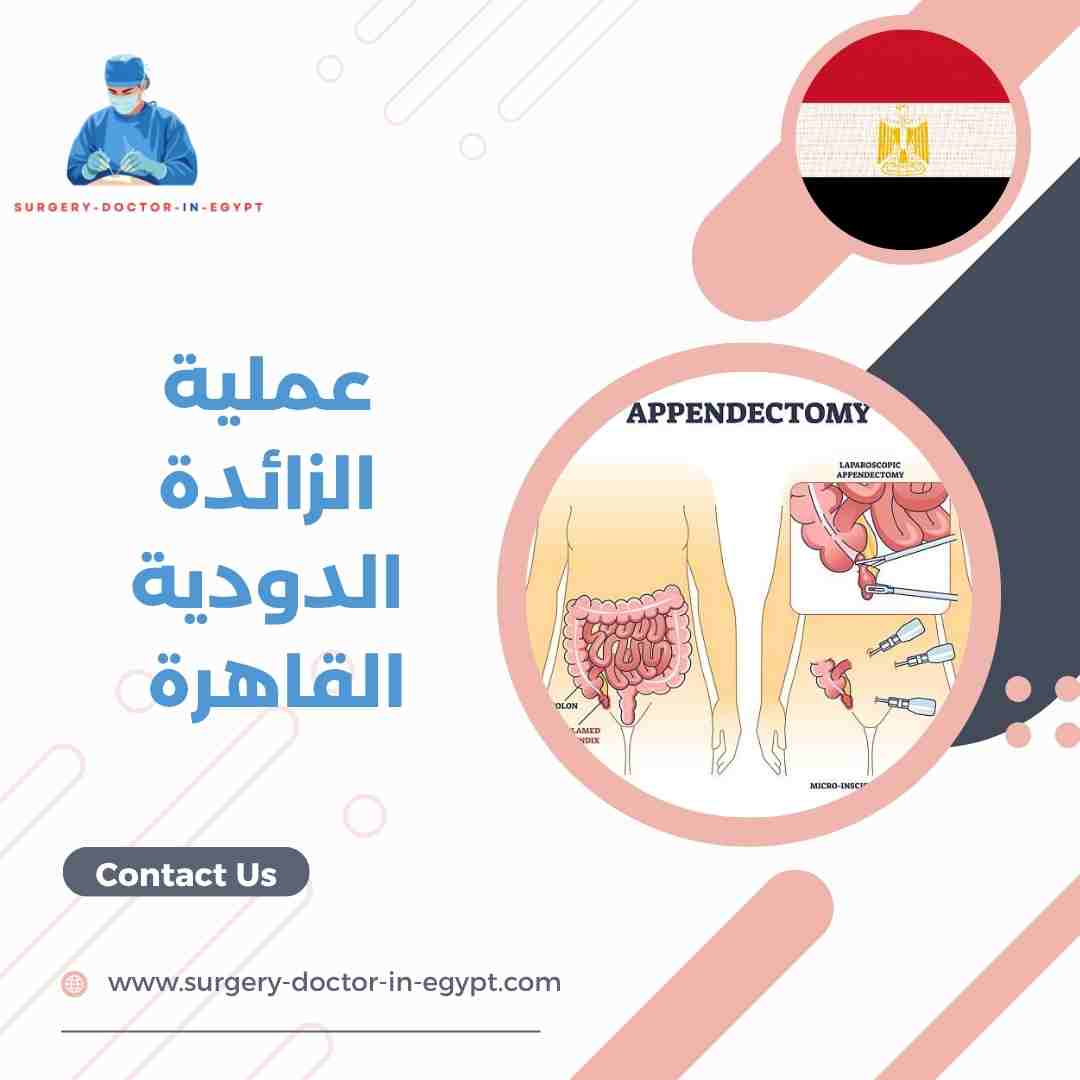 عملية الزائدة الدودية القاهرة