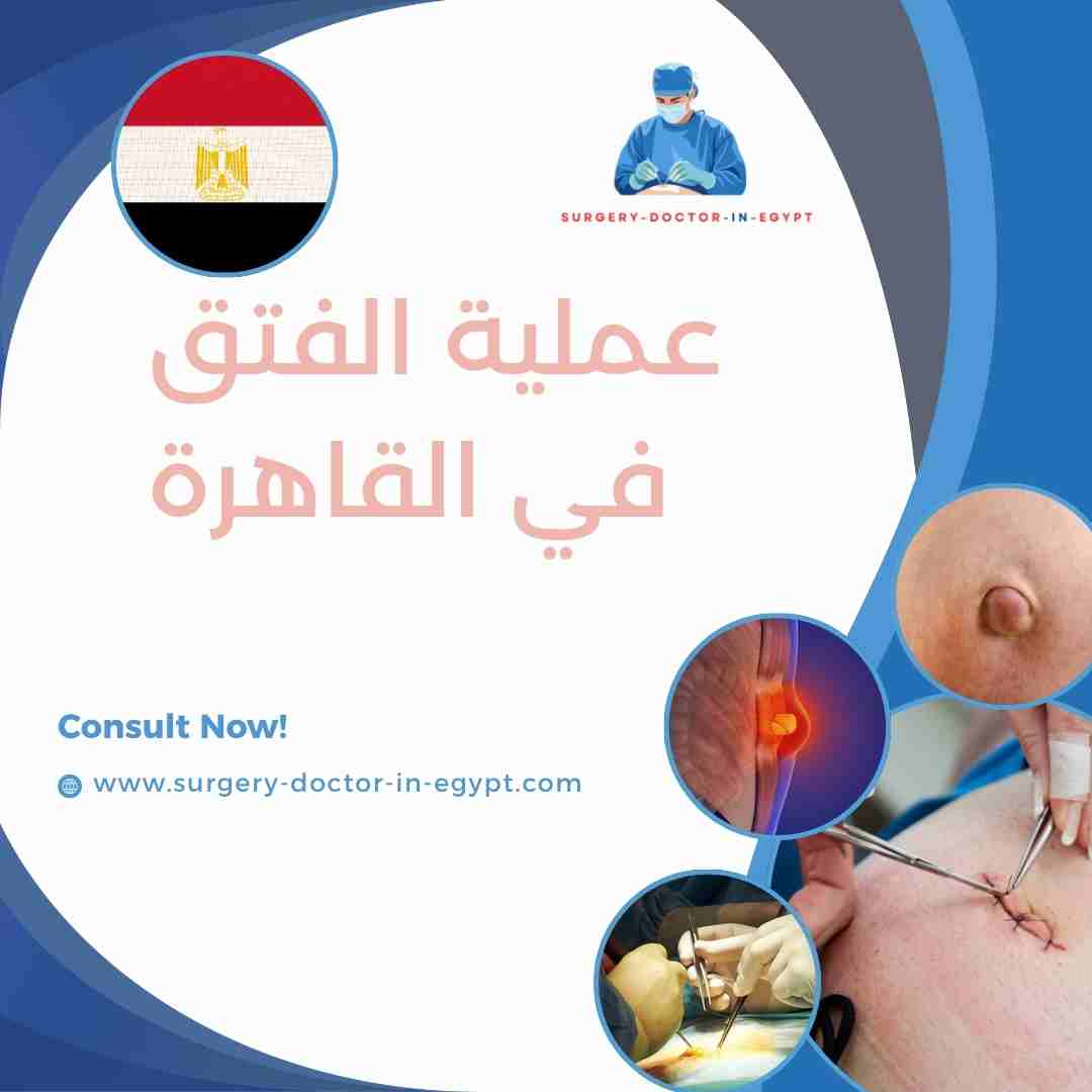 عملية الفتق في القاهرة